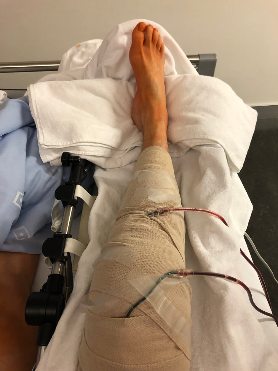 ACl Recovery with a CPM